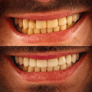 Pre: rotated centrals, gingival recession; Post: aligned teeth, restored papillae, natural translucency