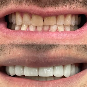 Pre: discolored, uneven upper incisors; Post: whiter, aligned teeth with improved gingival symmetry