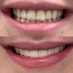 Pre: worn incisal edges, uneven lengths; Post: recontoured teeth, balanced incisal plane