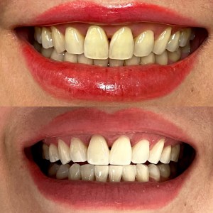 Pre: mild crowding + yellowing; Post: straighter alignment, brighter shade, no restorations visible