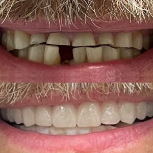 Pre: heavy staining and wear on upper/lower; Post: restored shade and contour, healthy pink gingiva