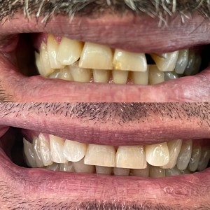 Pre: severe yellowing, chipping, diastema; Post: uniform veneers, closed gap, smooth margins